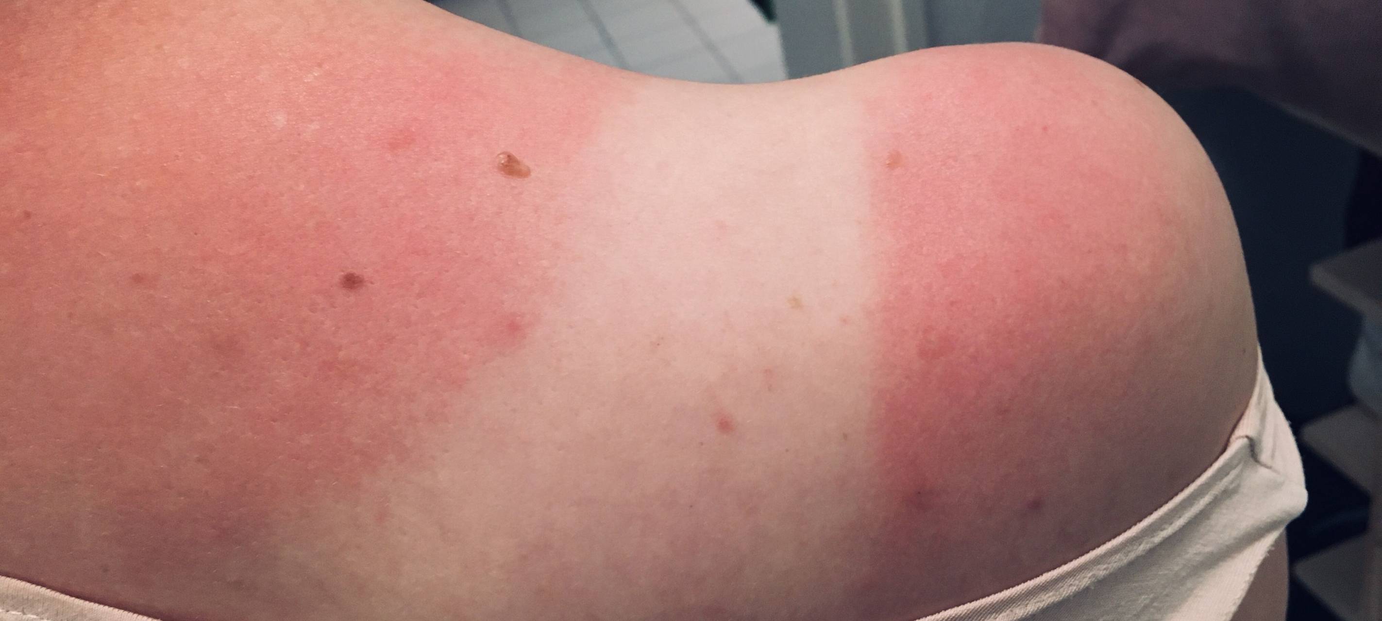 Lippstädter Hautarzt warnt vor Sonnenbrand